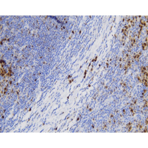 MUM1 (multiple myeloma oncogene-1)